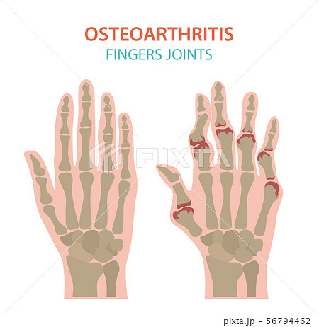 Arthritis, osteoarthritis medical infographic Arthritis, osteoarthritis medical infographic 56794462