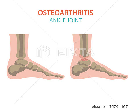 Arthritis, osteoarthritis medical infographic Arthritis, osteoarthritis medical infographic 56794467