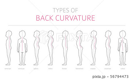 Types of kid`s back curvature. Medical disease 56794473