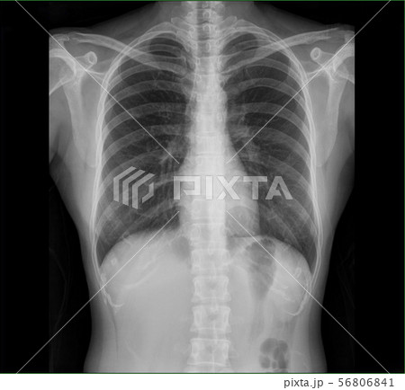 x-ray images chest lung 56806841