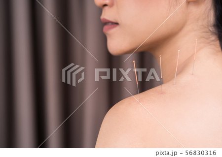 woman undergoing acupuncture treatment on shoulder woman undergoing acupuncture treatment on shoulder 56830316