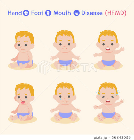 Hand, Foot, and Mouth Disease (HFMD) Medical 56843039
