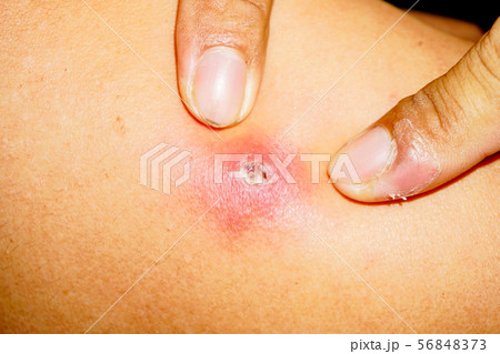 Acne skin problem on back side man surface Acne skin problem on back side man surface 56848373