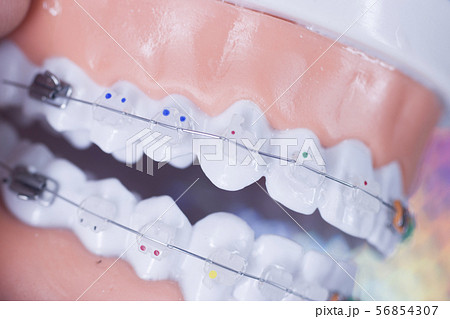 Dental brackets teeth straighteners 56854307