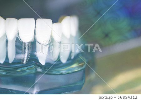 Dentist teeth implant dental model 56854312