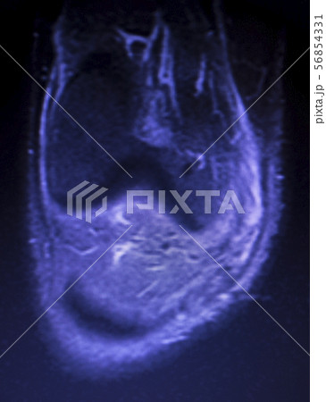 MRI knee meniscus tear scan 56854331