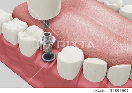 Dental Implants Treatment Procedure. Medically accurate 3D illustration dentures concept. 56895901