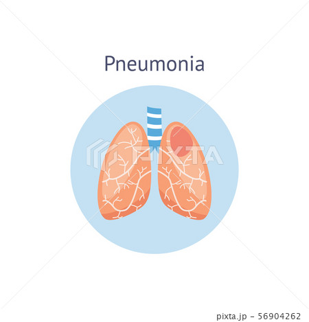 Pneumonia disease diagram a healthy and damaged lungs vector illustration isolated. Pneumonia disease diagram a healthy and damaged lungs vector illustration isolated. 56904262