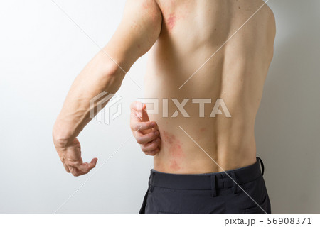 皮膚炎の男性 皮膚炎の男性 56908371