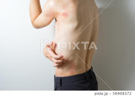 皮膚炎の男性 皮膚炎の男性 56908372