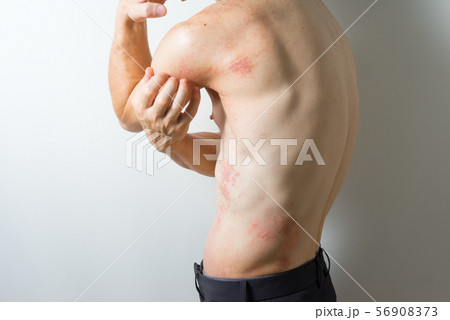 皮膚炎の男性 56908373