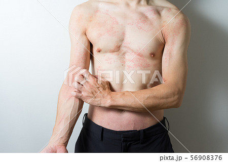 皮膚炎の男性 56908376