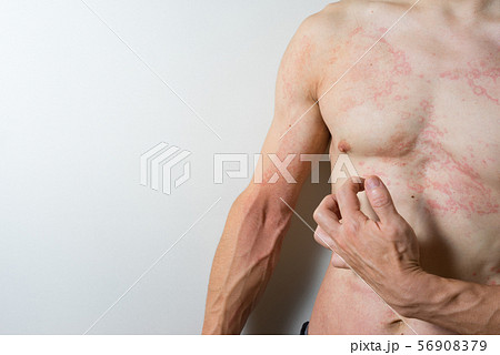 皮膚炎の男性 56908379
