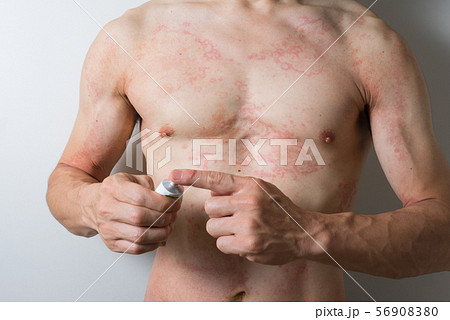 軟膏を塗る皮膚炎の男性 56908380
