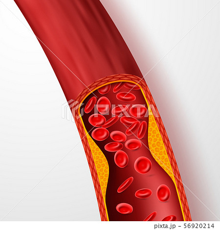 Blocked blood vessel, artery with cholesterol thrombus. 3d vein with clot vector illustration Blocked blood vessel, artery with cholesterol thrombus. 3d vein with clot vector illustration 56920214