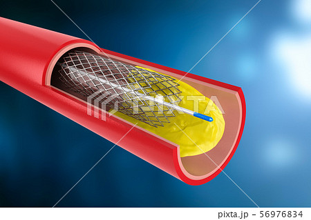 Balloon angioplasty procedure Balloon angioplasty procedure 56976834