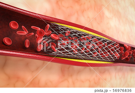 Balloon angioplasty procedure 56976836