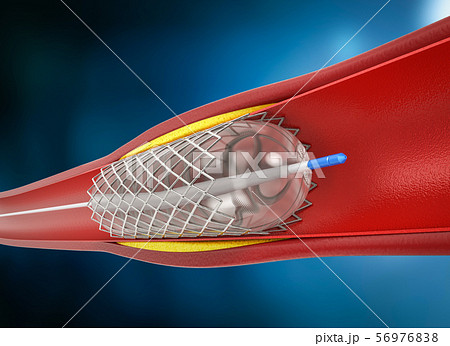 Balloon angioplasty procedure 56976838
