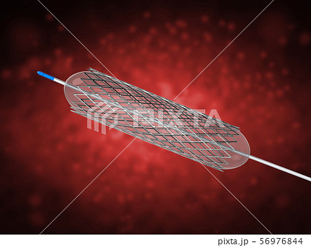 Stent for balloon angioplasty 56976844
