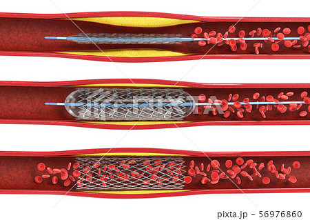 Balloon angioplasty procedure 56976860