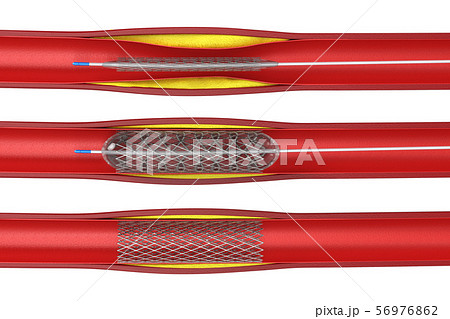 Balloon angioplasty procedure Balloon angioplasty procedure 56976862