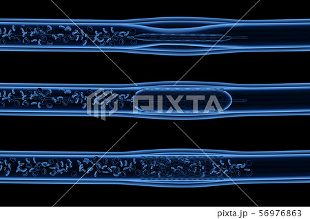 Balloon angioplasty procedure 56976863