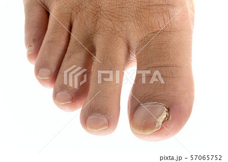 爪水虫で割れた男の足の親指の爪 爪水虫で割れた男の足の親指の爪 57065752