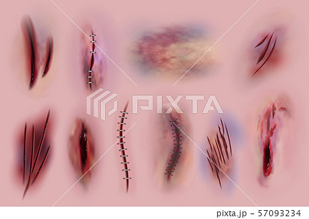 Bloody wounds. Scars, surgical stitches and bruis, skin cuts. Bloody wound textures vector isolated 57093234