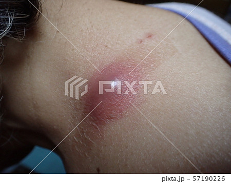 ふんりゅう（粉瘤） 57190226