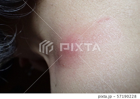 ふんりゅう(粉瘤) ふんりゅう(粉瘤) 57190228