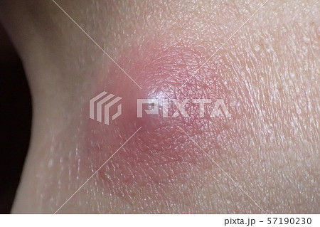 ふんりゅう（粉瘤） 57190230