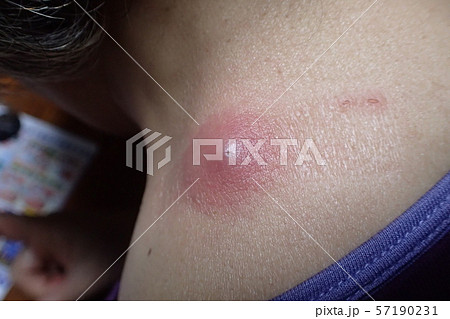 ふんりゅう（粉瘤） 57190231