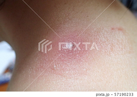 ふんりゅう（粉瘤） 57190233