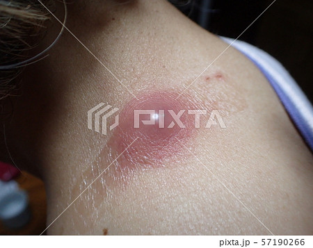 ふんりゅう（粉瘤） 57190266