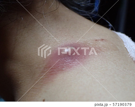 ふんりゅう（粉瘤） 57190379