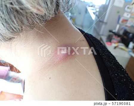 ふんりゅう(粉瘤) ふんりゅう(粉瘤) 57190381