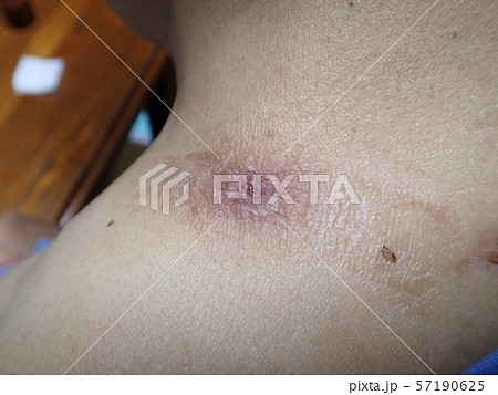 ふんりゅう（粉瘤） 57190625