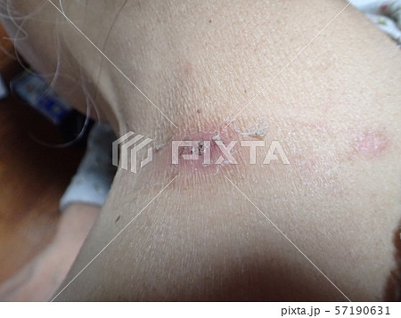 ふんりゅう(粉瘤) ふんりゅう(粉瘤) 57190631