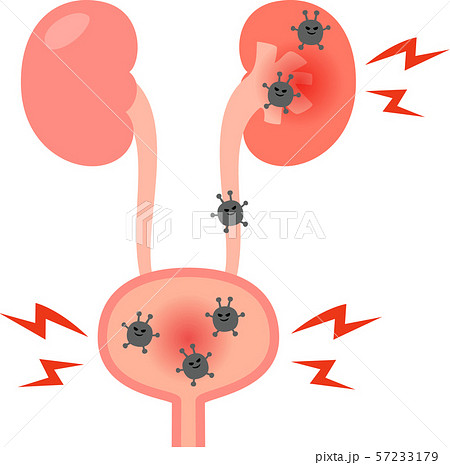 膀胱炎と腎盂腎炎のイメージのイラスト素材