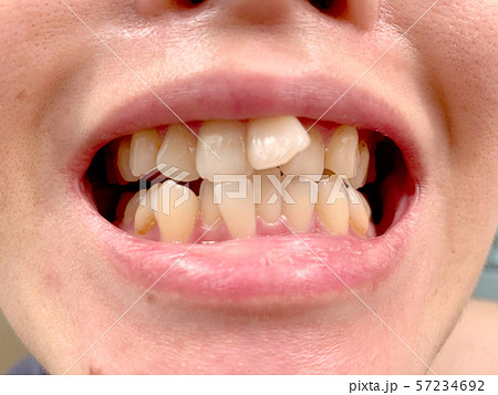 ガタガタの歯並びの写真素材