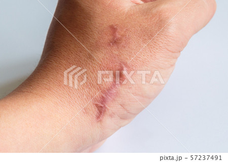The scar on his arm near the wrist on a white The scar on his arm near the wrist on a white 57237491