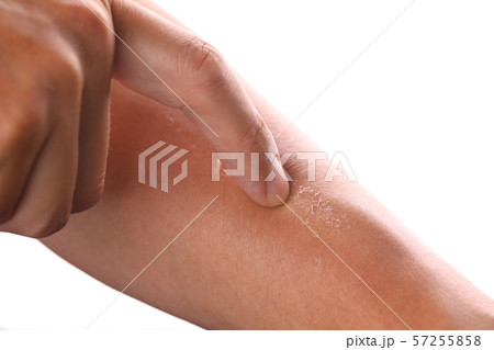 日焼のあとの皮膚の剥がれ 日焼のあとの皮膚の剥がれ 57255858