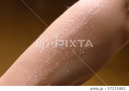 日焼のあとの皮膚の剥がれ 日焼のあとの皮膚の剥がれ 57255862