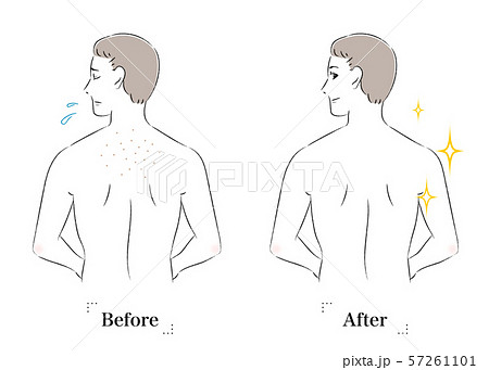 背中 肌 悩み 毛穴 黒ずみ ビフォーアフター 男性のイラスト素材