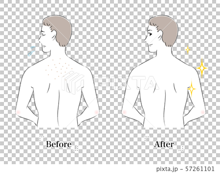 背中 肌 悩み 毛穴 黒ずみ ビフォーアフター 男性のイラスト素材