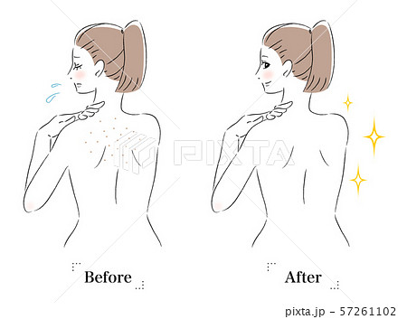 背中 肌 悩み 毛穴 黒ずみ ビフォーアフター 女性のイラスト素材