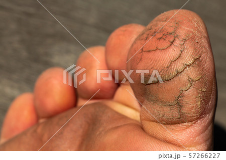 Woman's toe break skin on wood, Close up & Macro shot, Selective focus, Asian body skin part, Healthcare concept 57266227