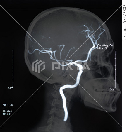 mri blood vessels mri blood vessels 57272802