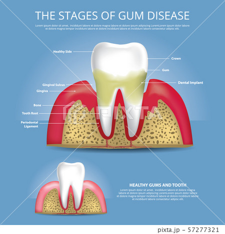 Human teeth Stages of Gum Disease Vector Illustration 57277321