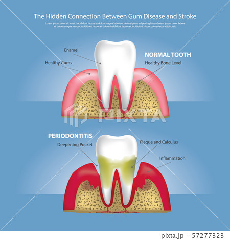 Human Teeth Stages Of Gum Disease Vector...のイラスト素材 [57277323] - PIXTA